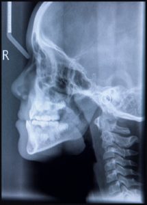 serious injury requirement accident attorneys