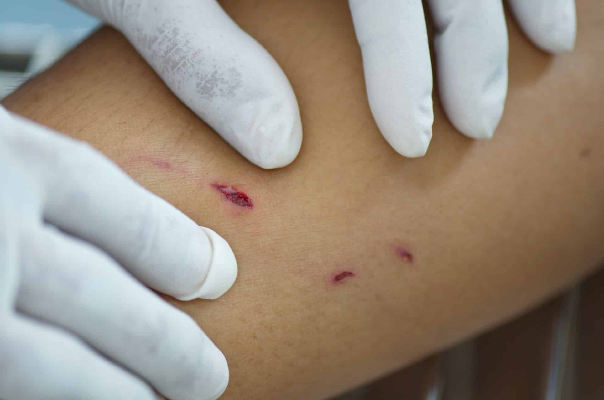 Dog Bite INjury Lawyers Bronx