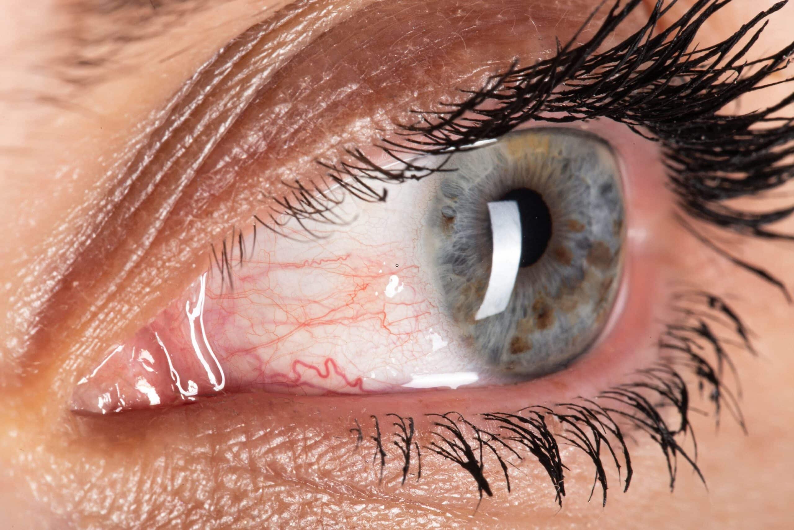 Steps to Take After an Eye Injury