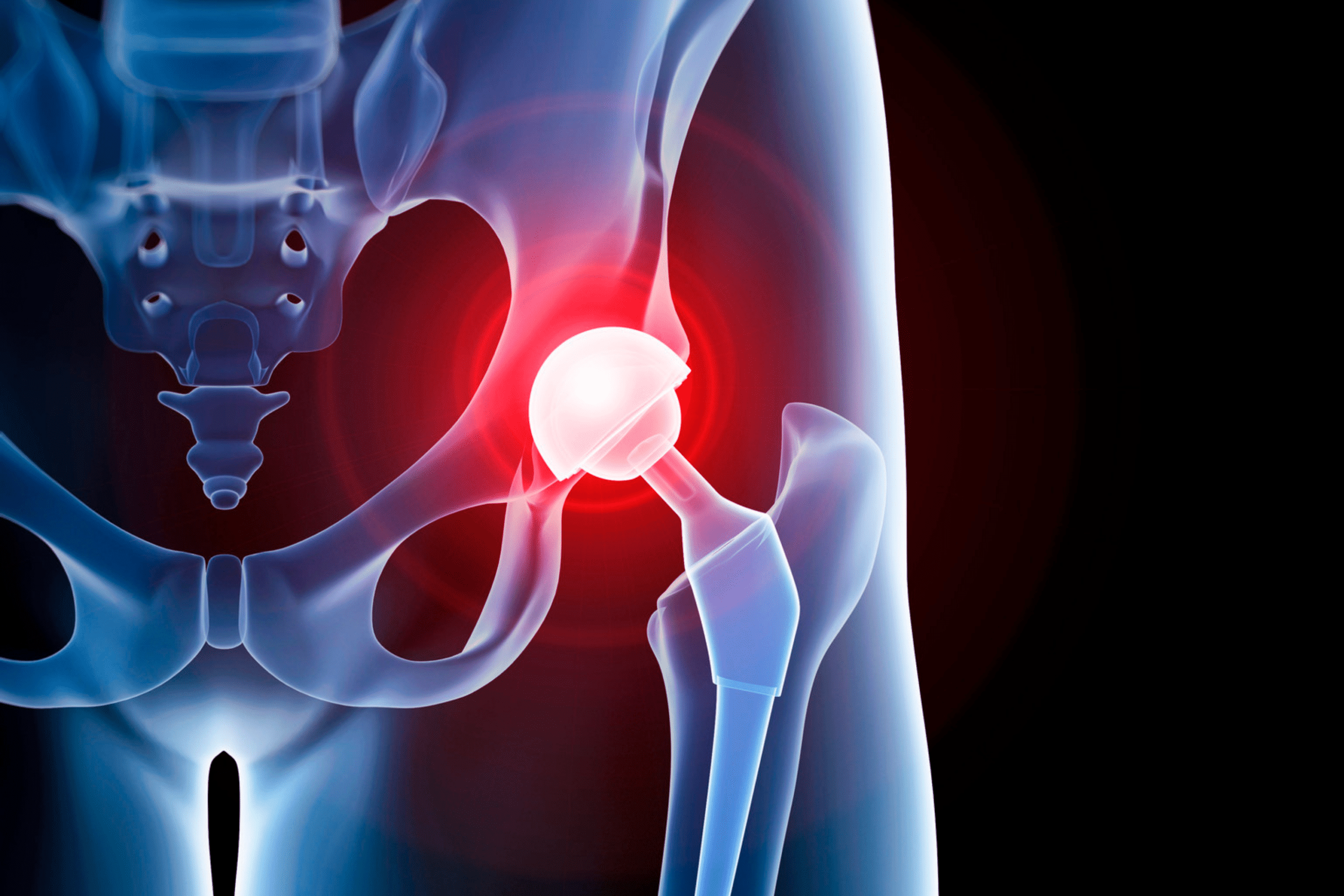Metal-on-Metal Hip Implants: Risks, Symptoms, and Legal Recourse in NY